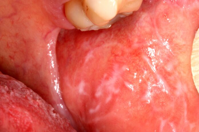 Top 7 Natural Solutions for Treating Oral Lichen Planus with Natural Remedies from Home.