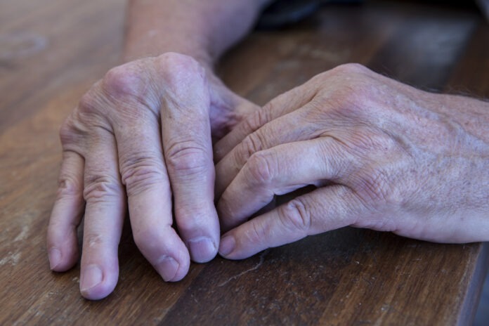 Ways to Naturally Aid Arthritis